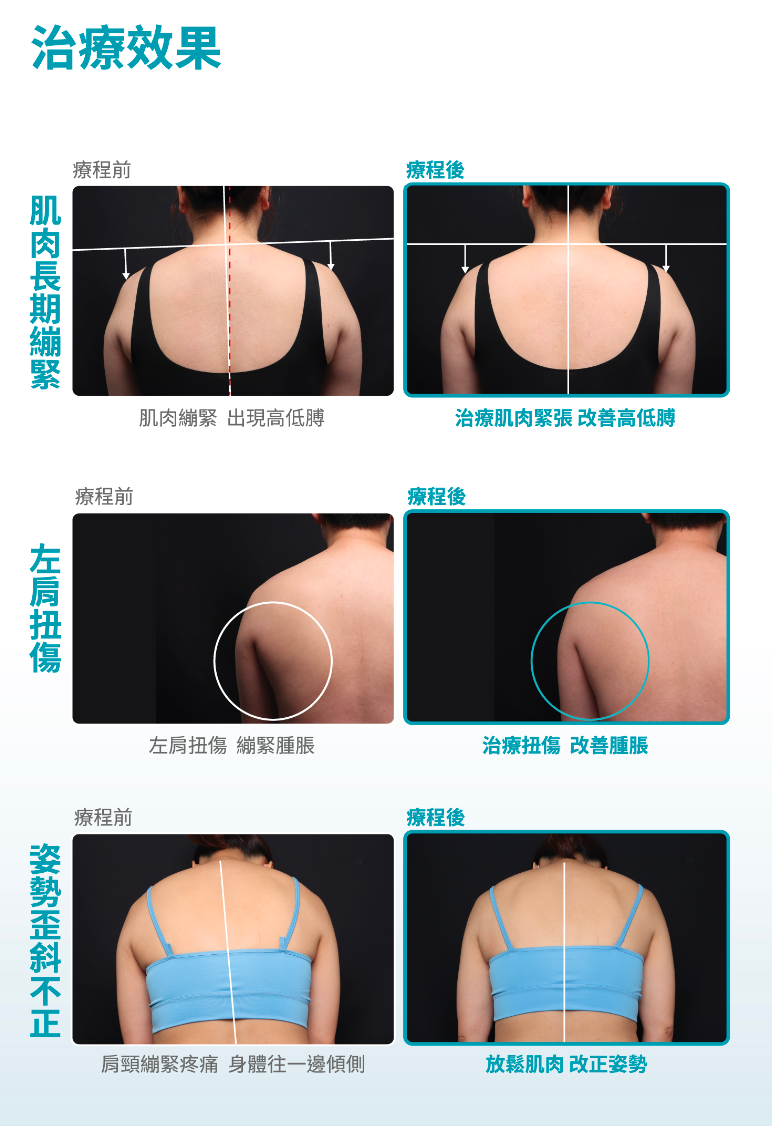 BTL SIS聚焦式電磁波 刷新止痛認知